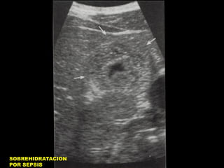 SOBREHIDRATACION
POR SEPSIS

 
