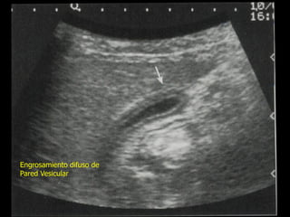 Engrosamiento difuso de
Pared Vesicular

 