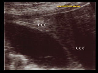COLECISTITIS AGUDA

 