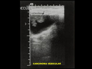 CARCINOMA VESICULAR

 