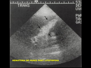 HEMATOMA DE PARED POST LITOTRIPSIA

 