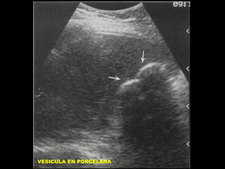 VESICULA EN PORCELANA

 