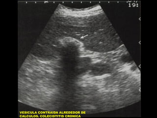 VESICULA CONTRAIDA ALREDEDOR DE
CALCULOS. COLECISTITIS CRONICA

 
