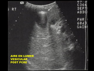 AIRE EN LUMEN
VESICULAR
POST PCRE

 