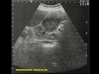 HEMORRAGIA VESICULAR

 