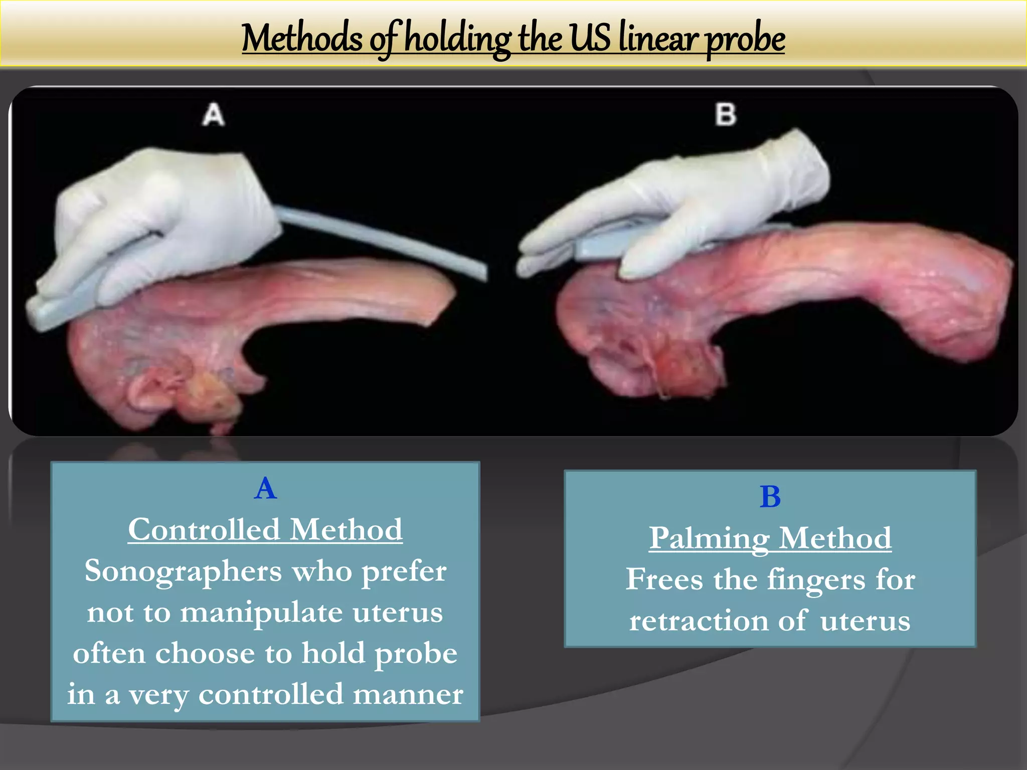 Methods of holding the US linear probe
A
Controlled Method
Sonographers who prefer
not to manipulate uterus
often choose to hold probe
in a very controlled manner
B
Palming Method
Frees the fingers for
retraction of uterus
 