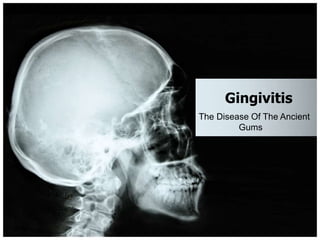 Gingivitis
The Disease Of The Ancient
Gums
 