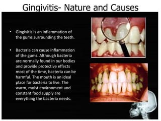 Gingivitis- Nature and Causes
• Gingivitis is an inflammation of
the gums surrounding the teeth.
• Bacteria can cause inflammation
of the gums. Although bacteria
are normally found in our bodies
and provide protective effects
most of the time, bacteria can be
harmful. The mouth is an ideal
place for bacteria to live. The
warm, moist environment and
constant food supply are
everything the bacteria needs.
 