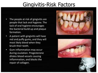 Gingivitis-Risk Factors
• The people at risk of gingivitis are
people that lack oral hygiene. The
lack of oral hygiene encourages
the bacterial build up and plaque
formation.
• A patient with gingivitis will have
red and puffy gums, and they will
most likely bleed when they
brush their teeth.
• Gum inflammation may occur
during ovulation. Progesterone
dilates blood vessels causing
inflammation, and blocks the
repair of collagen.
 
