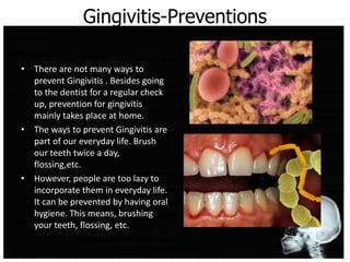 Gingivitis-Preventions
• There are not many ways to
prevent Gingivitis . Besides going
to the dentist for a regular check
up, prevention for gingivitis
mainly takes place at home.
• The ways to prevent Gingivitis are
part of our everyday life. Brush
our teeth twice a day,
flossing,etc.
• However, people are too lazy to
incorporate them in everyday life.
It can be prevented by having oral
hygiene. This means, brushing
your teeth, flossing, etc.
 