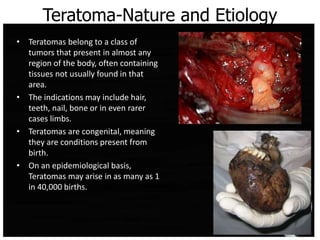Teratoma-Nature and Etiology
• Teratomas belong to a class of
tumors that present in almost any
region of the body, often containing
tissues not usually found in that
area.
• The indications may include hair,
teeth, nail, bone or in even rarer
cases limbs.
• Teratomas are congenital, meaning
they are conditions present from
birth.
• On an epidemiological basis,
Teratomas may arise in as many as 1
in 40,000 births.
 
