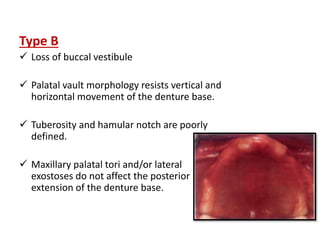 Type B
 Loss of buccal vestibule
 Palatal vault morphology resists vertical and
horizontal movement of the denture base.
 Tuberosity and hamular notch are poorly
defined.
 Maxillary palatal tori and/or lateral
exostoses do not affect the posterior
extension of the denture base.
 