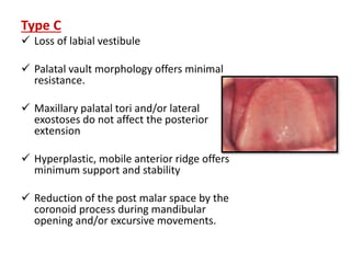 Type C
 Loss of labial vestibule
 Palatal vault morphology offers minimal
resistance.
 Maxillary palatal tori and/or lateral
exostoses do not affect the posterior
extension
 Hyperplastic, mobile anterior ridge offers
minimum support and stability
 Reduction of the post malar space by the
coronoid process during mandibular
opening and/or excursive movements.
 