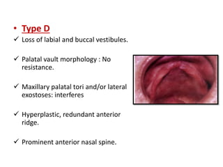 • Type D
 Loss of labial and buccal vestibules.
 Palatal vault morphology : No
resistance.
 Maxillary palatal tori and/or lateral
exostoses: interferes
 Hyperplastic, redundant anterior
ridge.
 Prominent anterior nasal spine.
 
