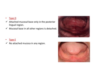 • Type D
 Attached mucosal base only in the posterior
lingual region.
 Mucosal base in all other regions is detached.
• Type E
 No attached mucosa in any region.
 