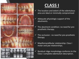 CLASS I
 The location and extent of the edentulous
area are ideal or minimally compromised
 Adequate physiologic support of the
abutments.
 The abutment condition: no need for pre-
prosthetic therapy.
 The occlusion : no need for pre-prosthetic
therapy
 Maxillomandibular relationship: Class I
molar and jaw relationships.
 Residual ridge morphology conforms to the
Class I complete edentulism description.
 
