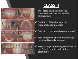 CLASS II
 The location and extent of the
edentulous area are moderately
compromised
 Condition of the abutments is
moderately compromised
 Occlusion is moderately compromised
 Maxillomandibular relationship: Class I
molar and jaw relationships.
 Residual ridge morphology conforms to
the Class II complete edentulism
description.
.
 