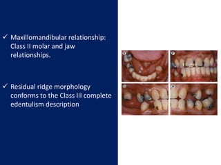  Maxillomandibular relationship:
Class II molar and jaw
relationships.
 Residual ridge morphology
conforms to the Class III complete
edentulism description
 