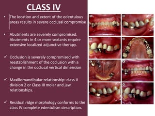 CLASS IV
• The location and extent of the edentulous
areas results in severe occlusal compromise
• Abutments are severely compromised:
Abutments in 4 or more sextants require
extensive localized adjunctive therapy.
 Occlusion is severely compromised with
reestablishment of the occlusion with a
change in the occlusal vertical dimension
 Maxillomandibular relationship: class II
division 2 or Class III molar and jaw
relationships.
 Residual ridge morphology conforms to the
class IV complete edentulism description.
 