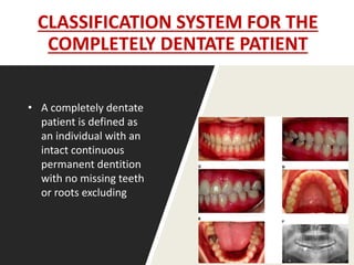 CLASSIFICATION SYSTEM FOR THE
COMPLETELY DENTATE PATIENT
• A completely dentate
patient is defined as
an individual with an
intact continuous
permanent dentition
with no missing teeth
or roots excluding
 