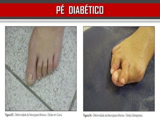 PÉ DIABÉTICOPÉ DIABÉTICO
 