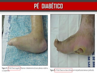 PÉ DIABÉTICOPÉ DIABÉTICO
 