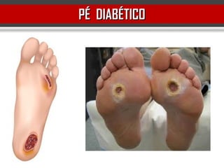 PÉ DIABÉTICOPÉ DIABÉTICO
 