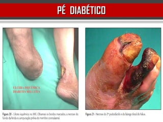 PÉ DIABÉTICOPÉ DIABÉTICO
 