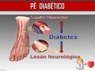 PÉ DIABÉTICOPÉ DIABÉTICO
 