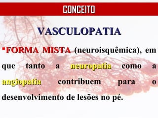VASCULOPATIAVASCULOPATIA
FORMA MISTAFORMA MISTA (neuroisquêmica), em
que tanto a neuropatianeuropatia como a
angiopatiaangiopatia contribuem para o
desenvolvimento de lesões no pé.
CONCEITOCONCEITO
 