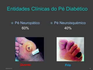 Entidades Clínicas do Pé Diabético
Quente Frio
 Pé Neuropático
60%
 Pé Neuroisquémico
40%
1930/05/2015
 
