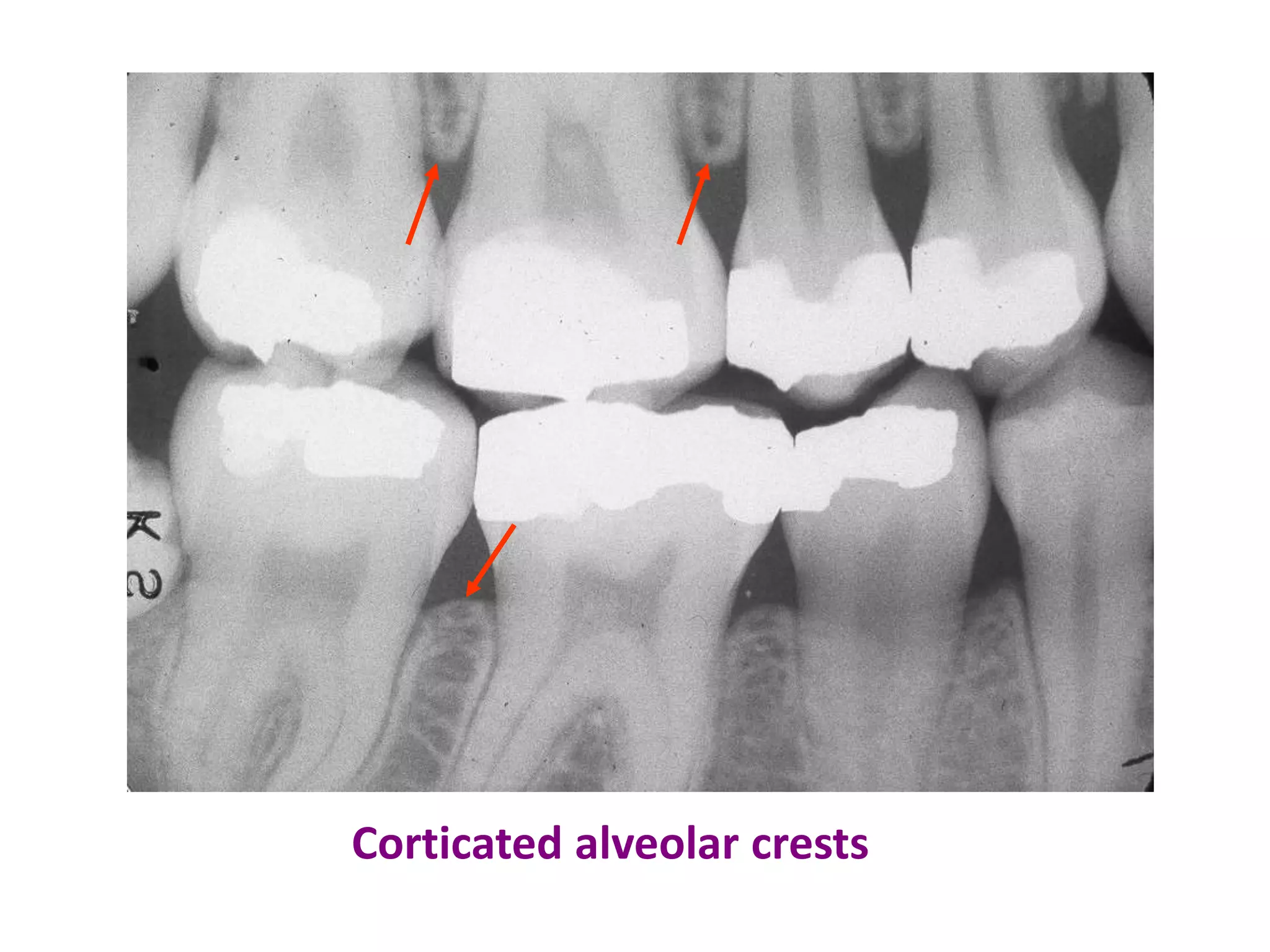 Corticated alveolar crests
 