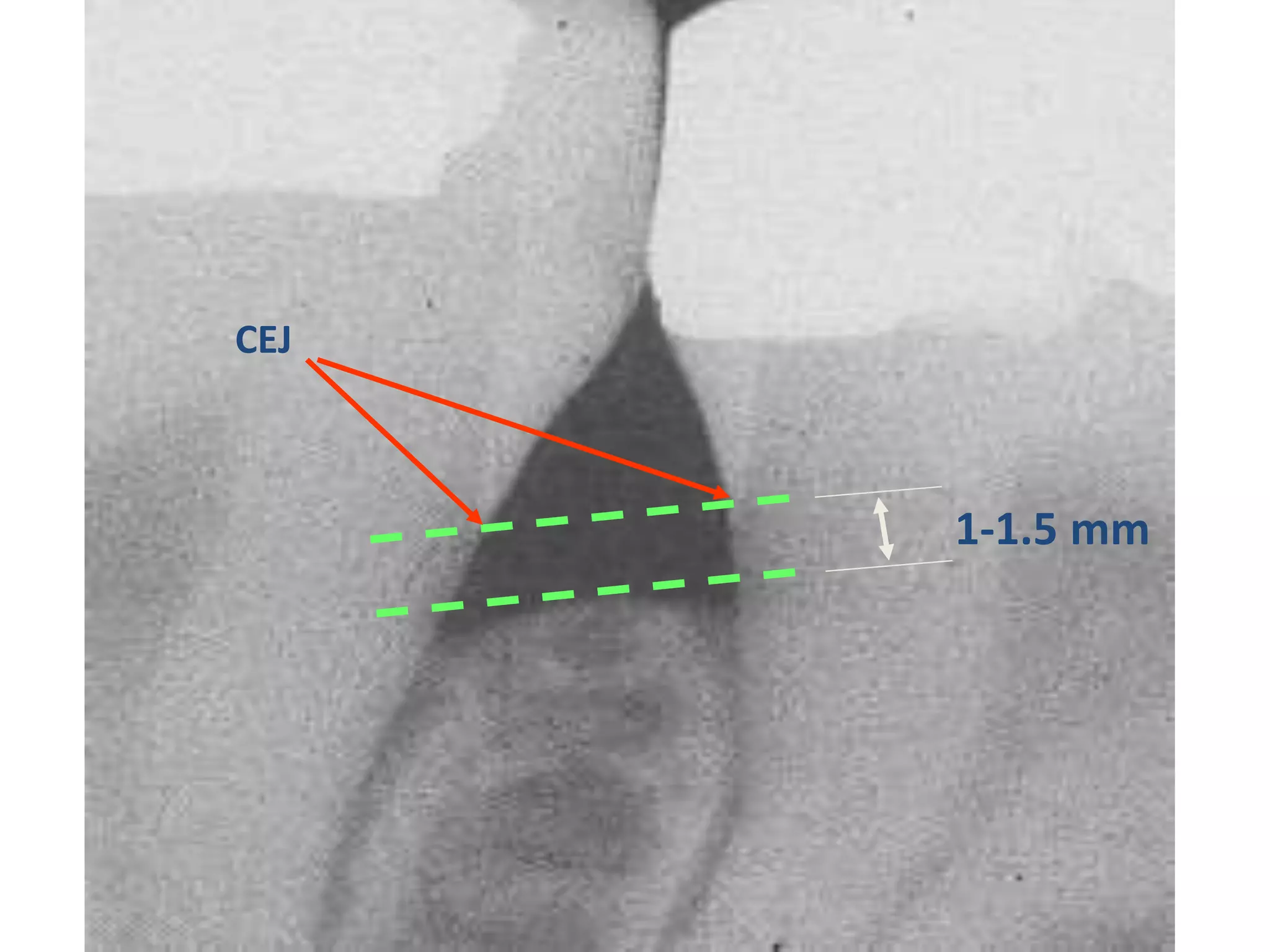 CEJ



      1-1.5 mm
 