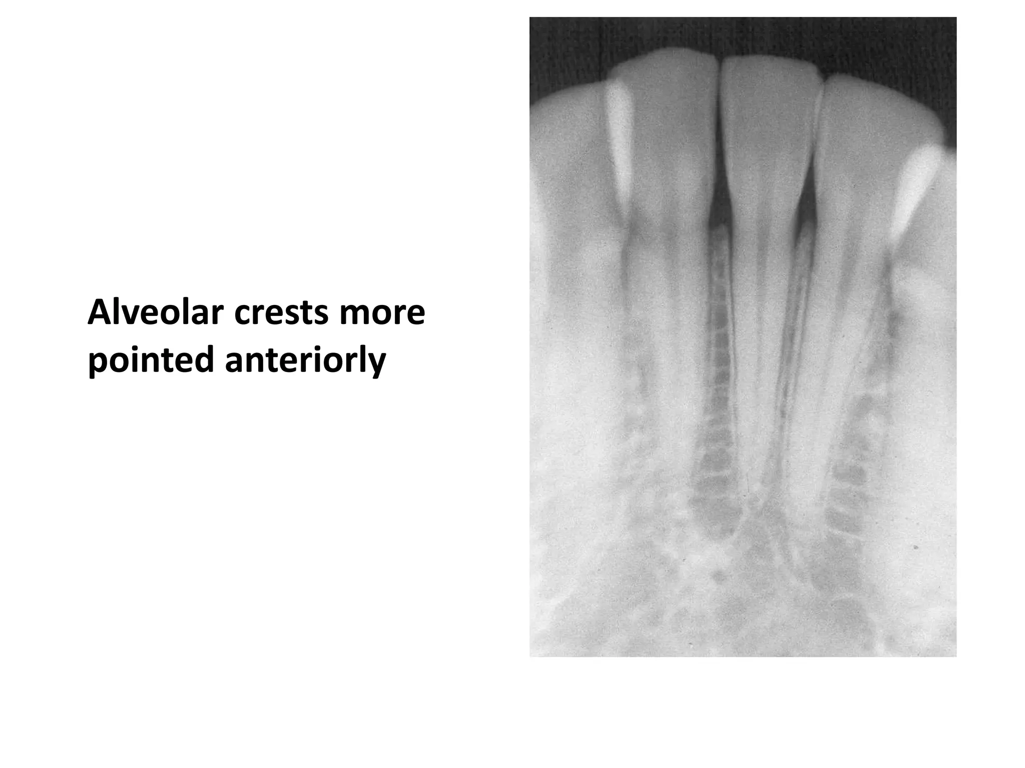Alveolar crests more
pointed anteriorly
 