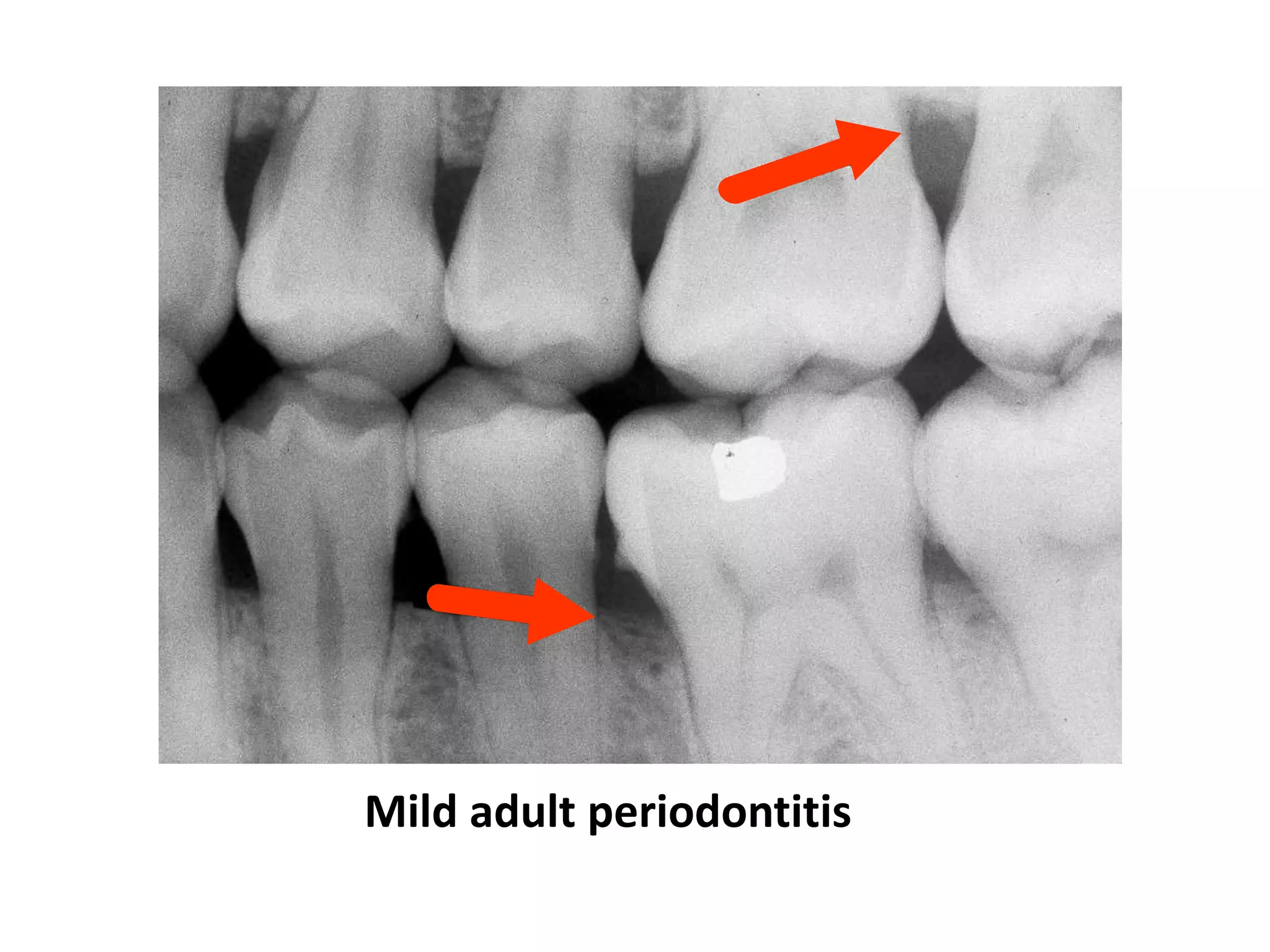 Mild adult periodontitis
 