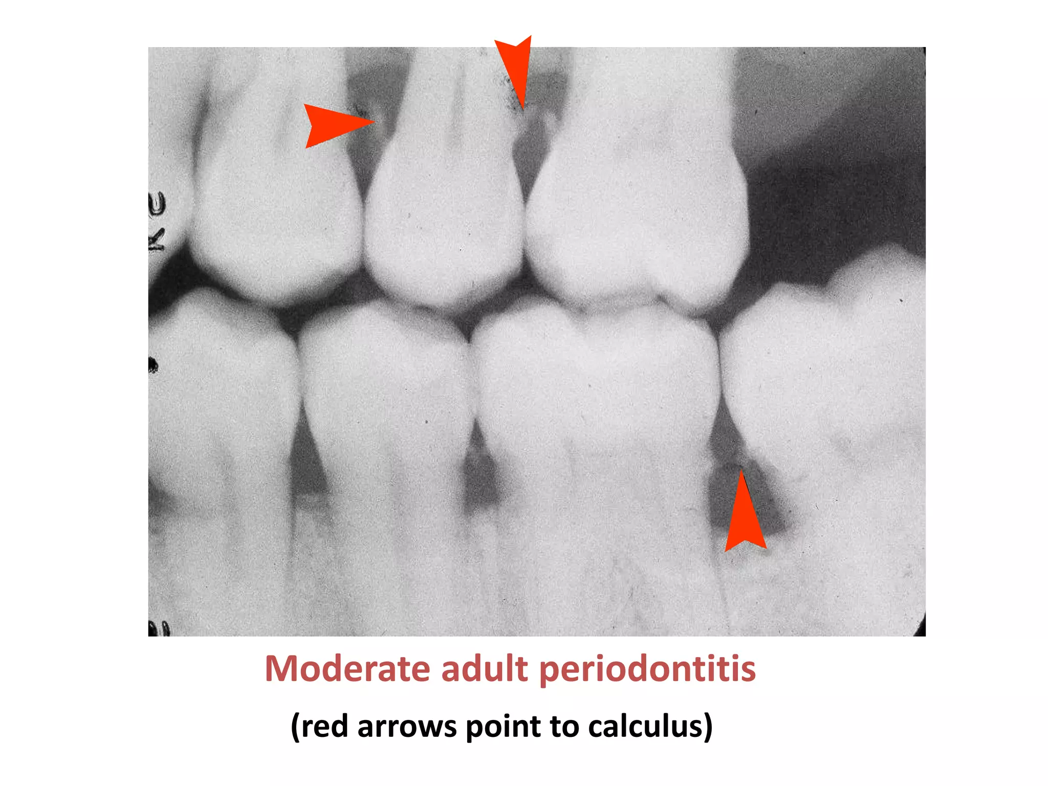 Moderate adult periodontitis
 (red arrows point to calculus)
 
