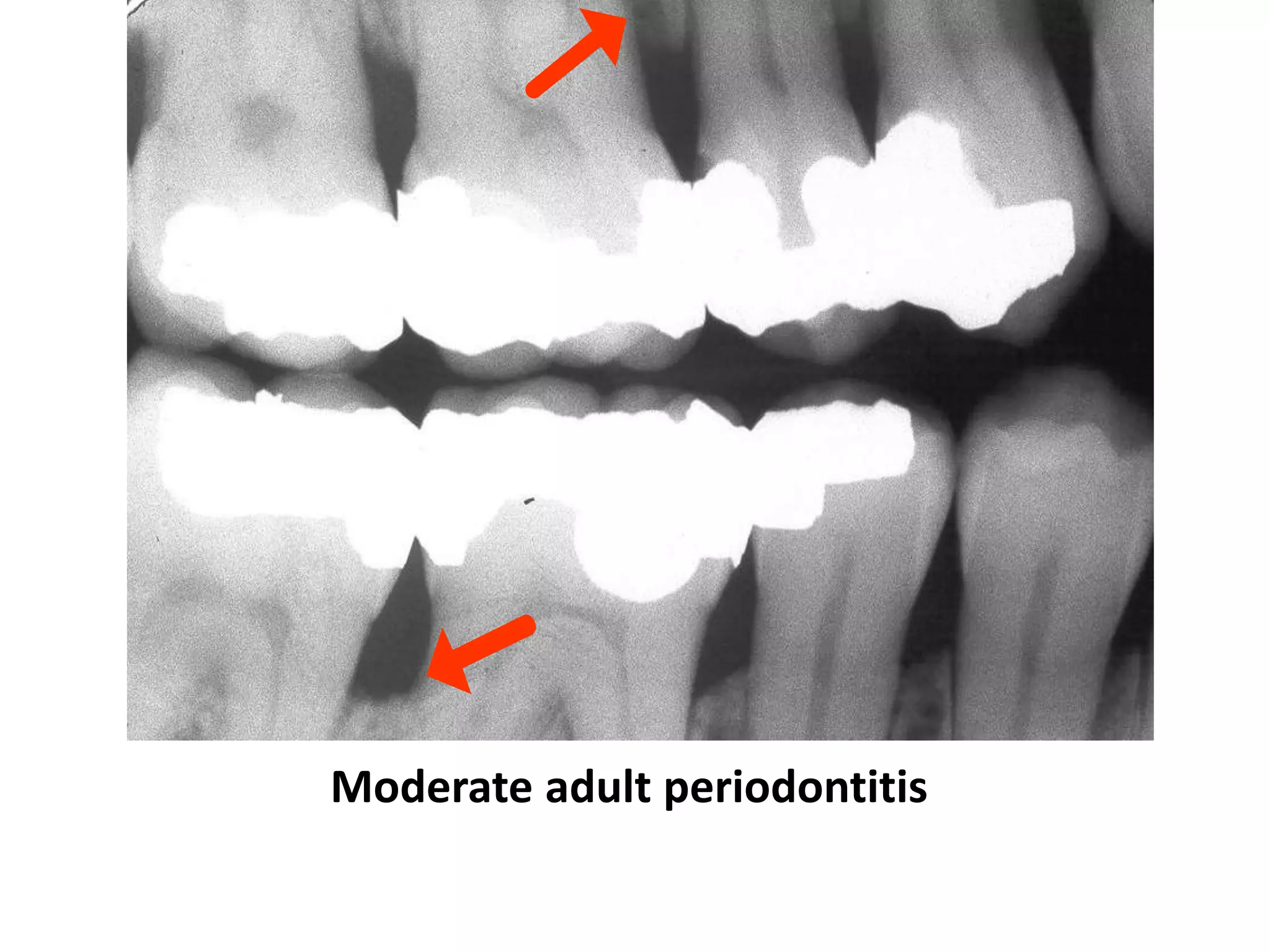 Moderate adult periodontitis
 