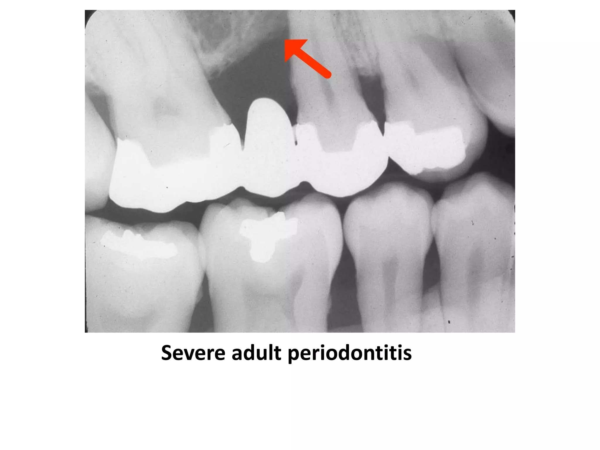 Severe adult periodontitis
 
