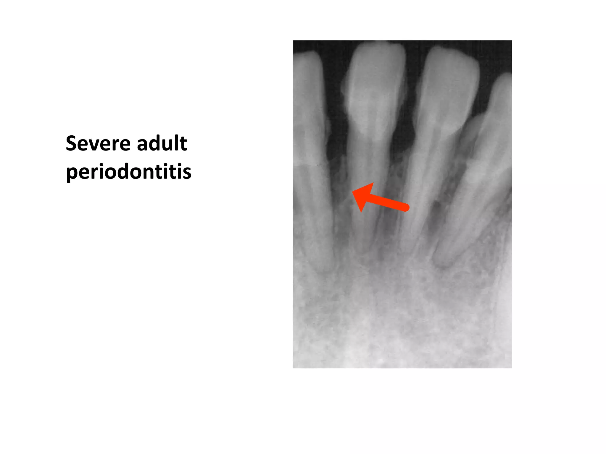 Severe adult
periodontitis
 