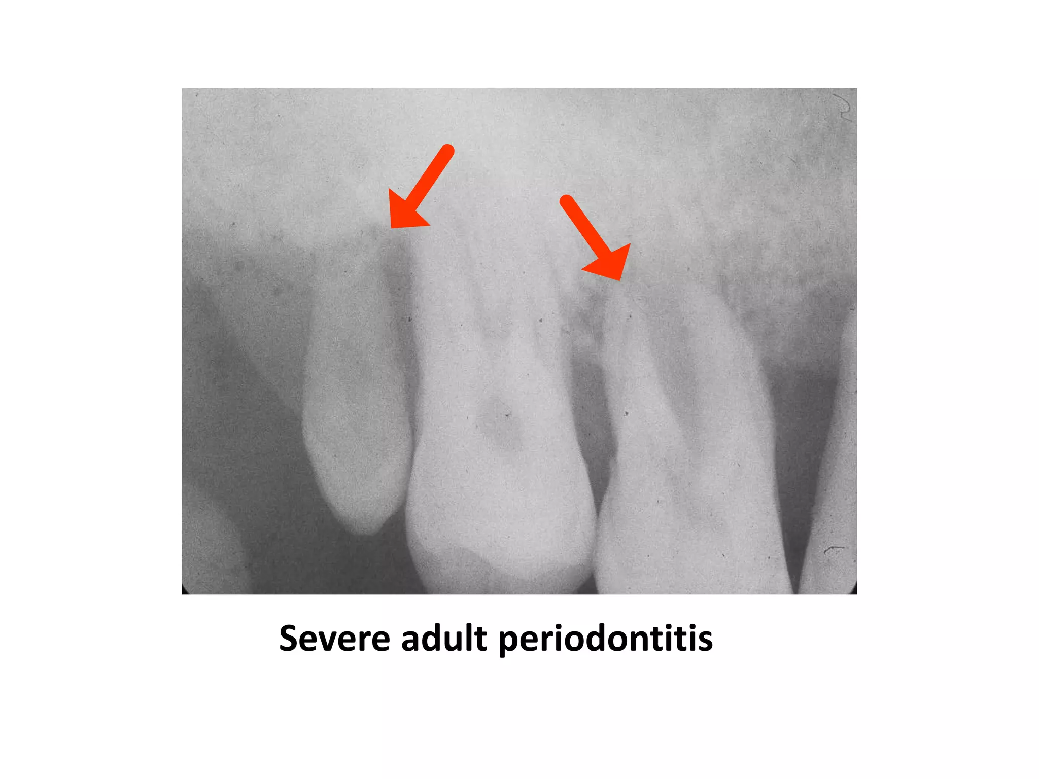 Severe adult periodontitis
 