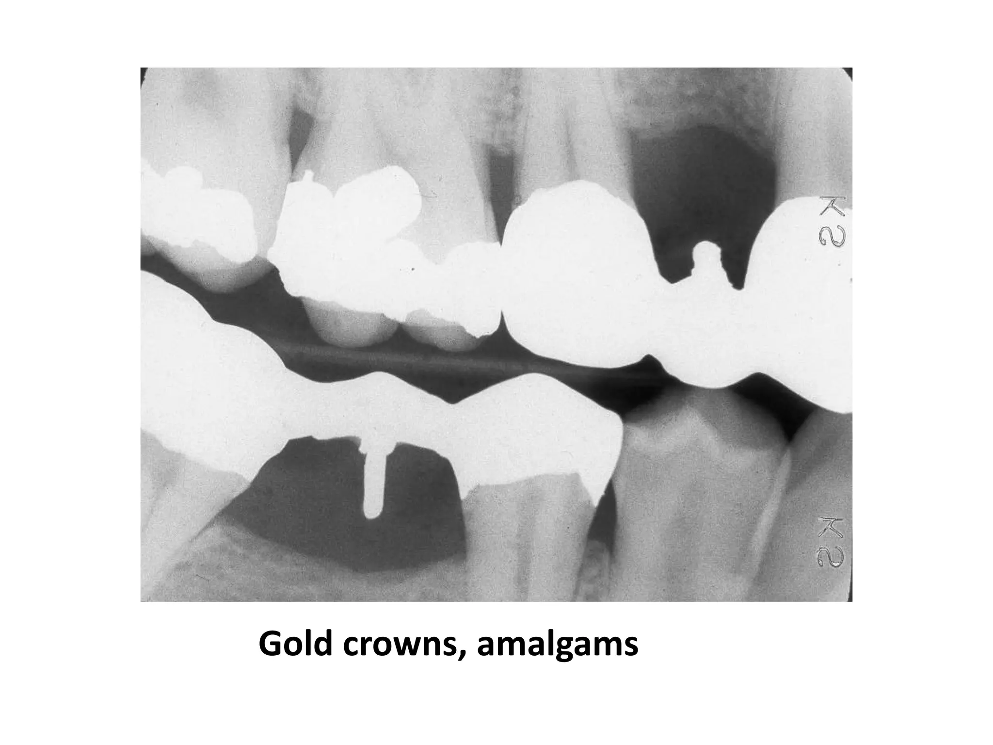 Gold crowns, amalgams
 