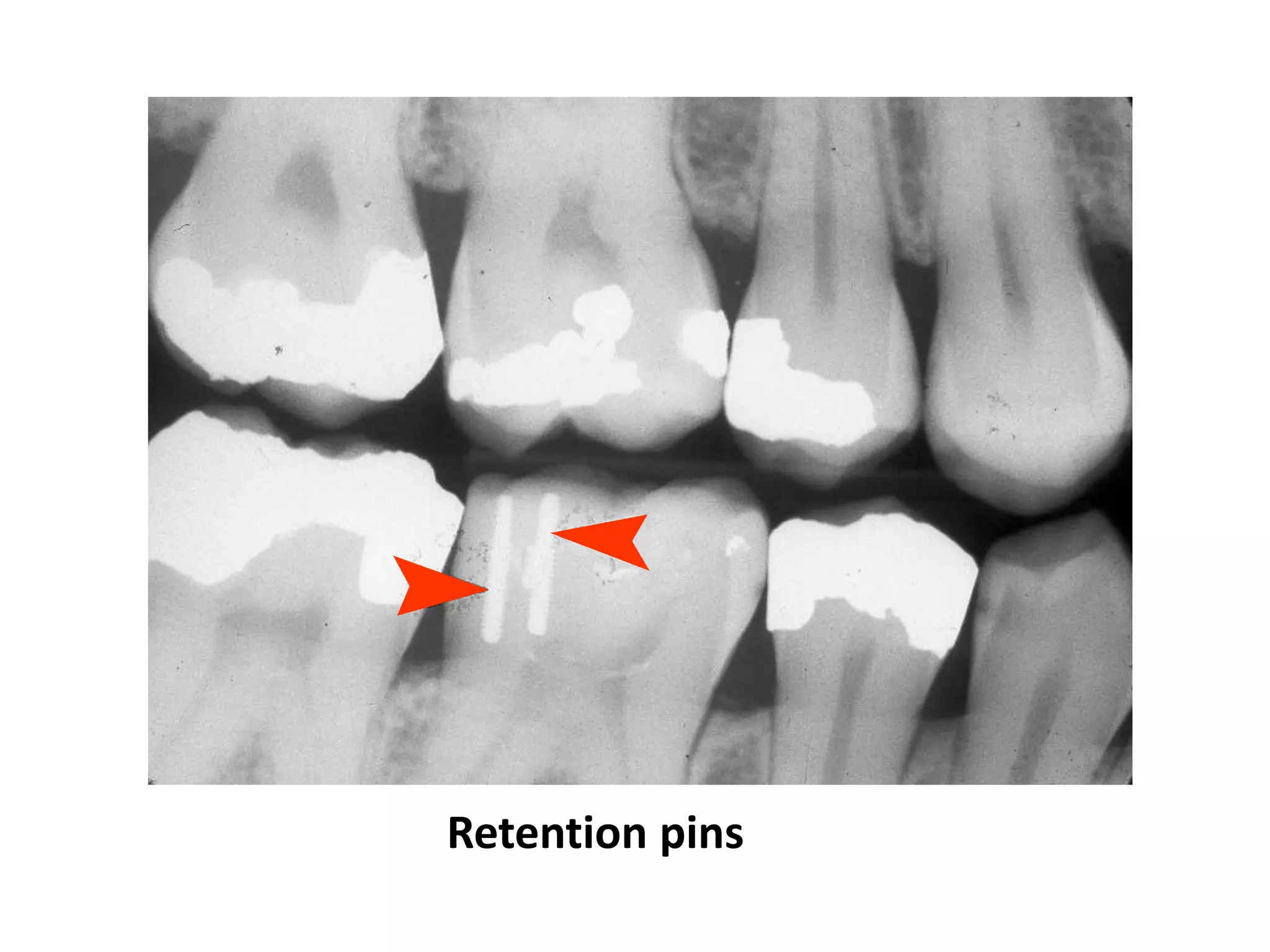 Retention pins
 