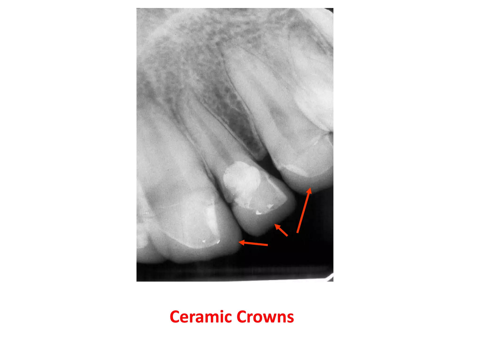 porcelain
            crowns



Ceramic Crowns
 