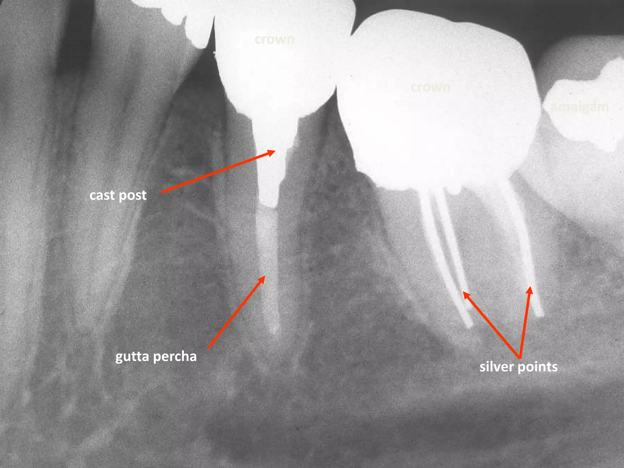 crown


                           crown
                                              amalgam




cast post




    gutta percha
                                   silver points
 