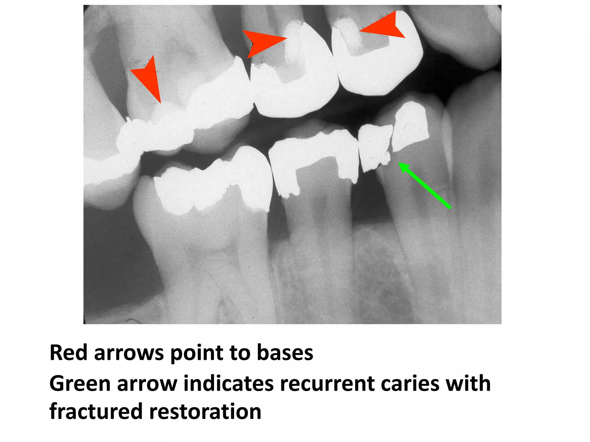 Red arrows point to bases
Green arrow indicates recurrent caries with
fractured restoration
 