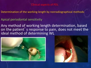 Clinical aspects of PDL
Determination of the working length by nonradiographical methods
Apical periodontal sensitivity
Any method of working length determination, based
on the patient’s response to pain, does not meet the
ideal method of determining WL
 