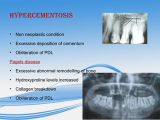 HYPERCEMENTOSIS
• Non neoplastic condition
• Excessive deposition of cementum
• Obliteration of PDL
Pagets disease
• Excessive abnormal remodelling of bone
• Hydroxyproline levels increased
• Collagen breakdown
• Obliteration of PDL
 
