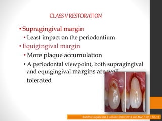 CLASSVRESTORATION
• Supragingival margin
• Least impact on the periodontium
• Equigingival margin
• More plaque accumulation
• A periodontal viewpoint, both supragingival
and equigingival margins are well
tolerated
Babitha Nugala etal J Conserv Dent 2012 Jan-Mar; 15(1): 12–17
 