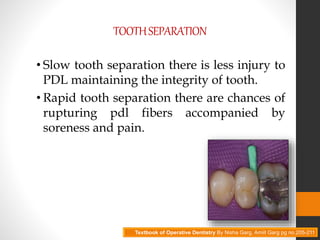 TOOTHSEPARATION
• Slow tooth separation there is less injury to
PDL maintaining the integrity of tooth.
• Rapid tooth separation there are chances of
rupturing pdl fibers accompanied by
soreness and pain.
Textbook of Operative Dentistry By Nisha Garg, Amiit Garg pg no.205-211
 