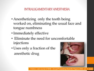 INTRALIGAMENTARYANESTHESIA
• Anesthetizing only the tooth being
worked on, eliminating the usual face and
tongue numbness
• Immediately effective
• Eliminate the need for uncomfortable
injections
• Uses only a fraction of the
anesthetic drug
• 2
Hristina L etal Journal of IMAB - Annual Proceeding (Scientific Papers) 2005, vol. 11, book
 